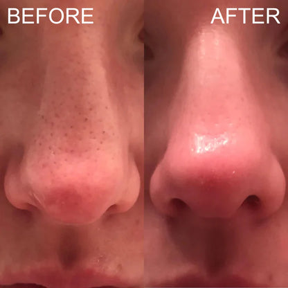 Blackhead Remover Suction Machine